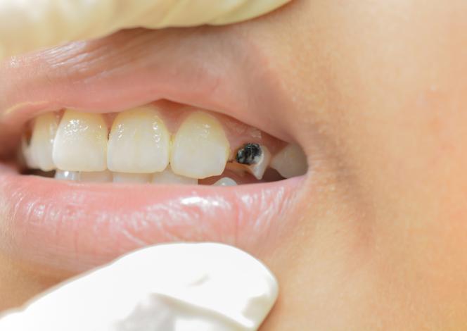 Dente marcio sotto capsula Dente marcio sotto capsula