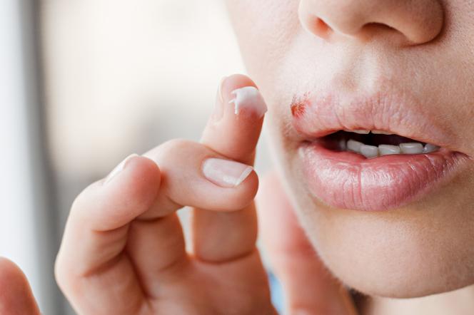 Herpes labiale quando preoccuparsi Herpes labiale quando preoccuparsi