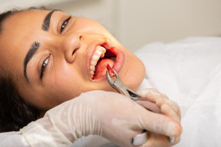 Infezione dente del giudizio: cause, sintomi e trattamenti