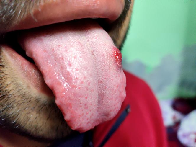 Leucoplachia a chi rivolgersi Leucoplachia a chi rivolgersi