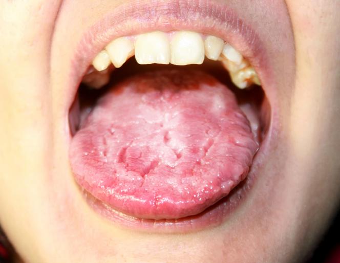 Mucosite orale immagini Mucosite orale immagini