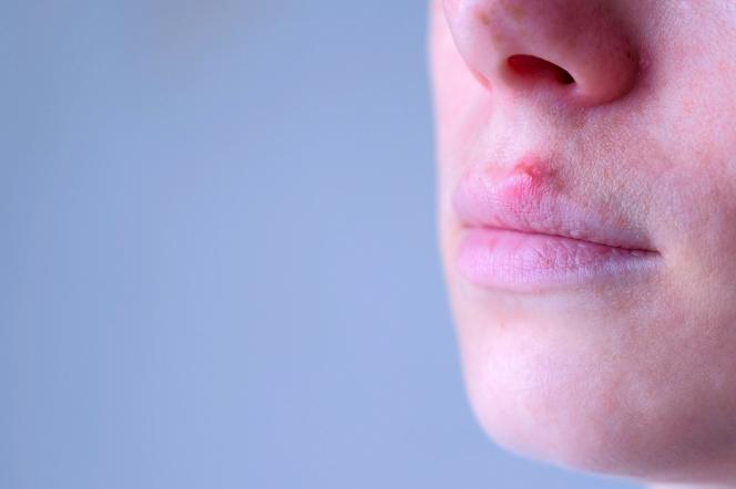 papilloma squamoso dell ugola negi genitale la bărbați prin transmisie