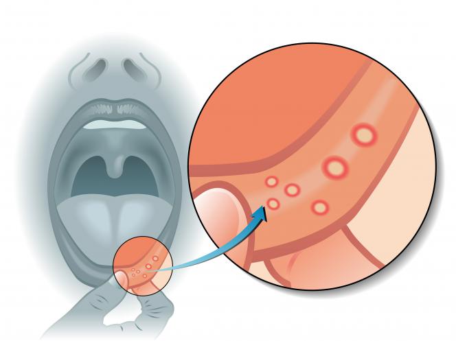 Papilloma virus labbra bocca
