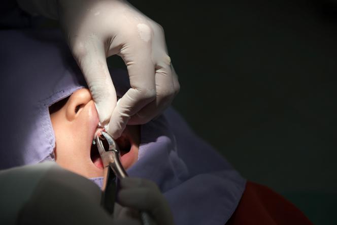 Rottura coagulo dopo estrazione dente Rottura coagulo dopo estrazione dente