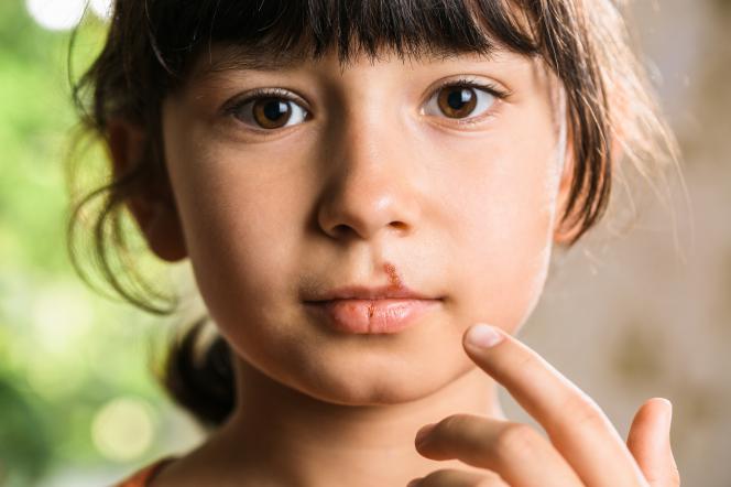 Stomatite erpetica bambini Stomatite erpetica bambini