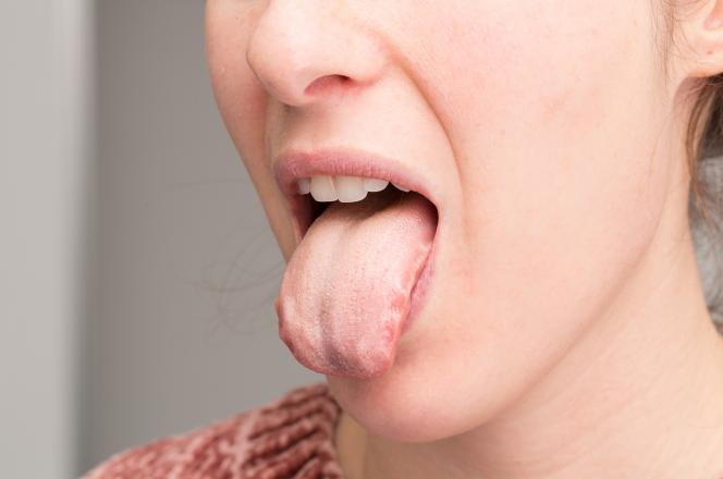 Stomatite lingua immagini Stomatite lingua immagini
