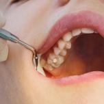 Carie tra due denti