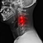 Cervicale denti tensione