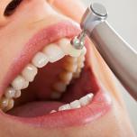 Decalcificazione denti