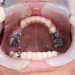 Denti cariati non curati