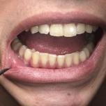 Denti neri alla radice