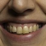 Denti verdi