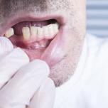 Dolore alle gengive senza denti