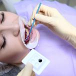 Gel antibiotico per parodontite 