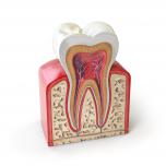 Nervo scoperto dente