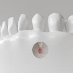 Pulpite dente devitalizzato