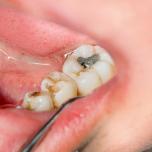 Pulpite dente