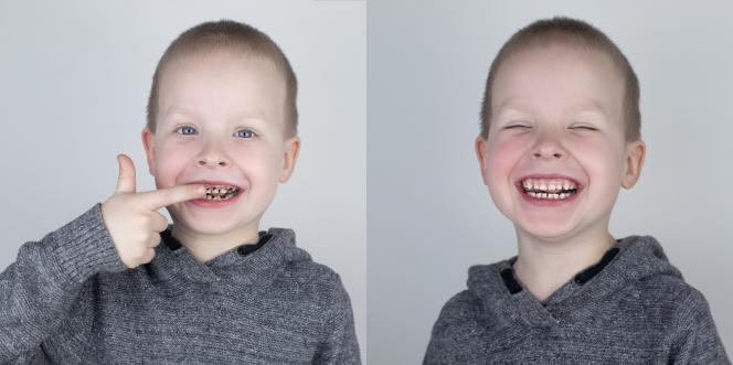 Carie bambini immagini Carie bambini immagini