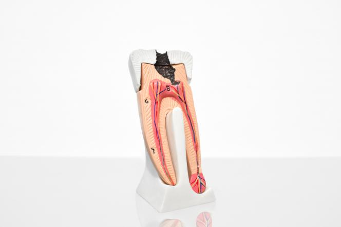 Dente cariato Dente cariato