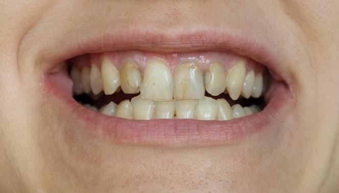 Dente Crepato Rimedi Per Riparare Denti Rotti O Scheggiati