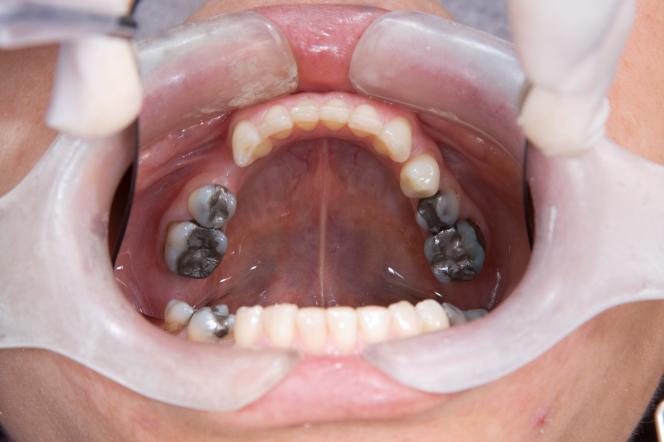 Tutti denti cariati Tutti denti cariati