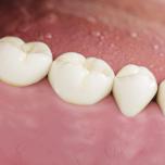 Cemento provvisorio denti quanto dura