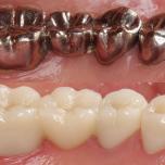 Denti d'argento