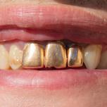 Denti d'oro finti