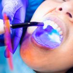 Denti in resina prezzi