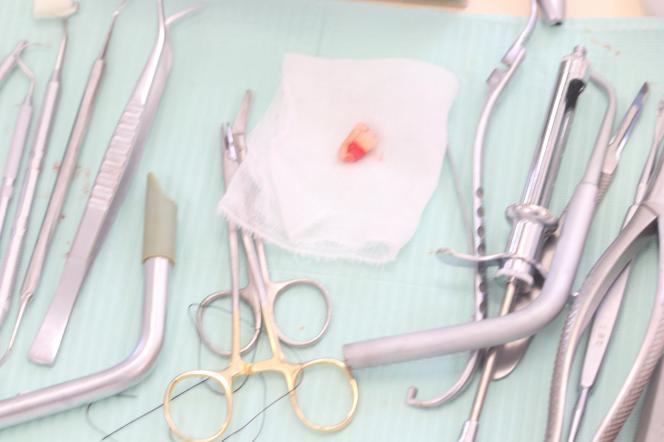 Dente provvisorio dopo estrazione Dente provvisorio dopo estrazione