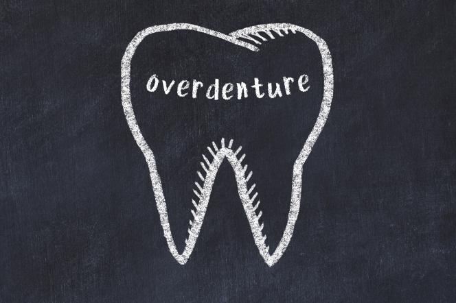 Overdenture Overdenture