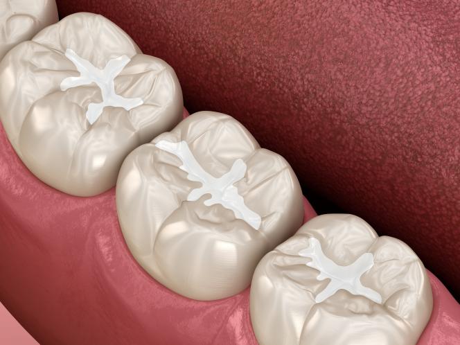 Strumento Dentale Doppia Estremità: Bruciatore A Sfera Per Amalgama E Composito - Medspo