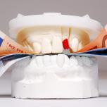 Dentiera a 350 euro