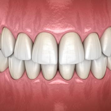 Dentiera fissa