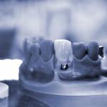 Abutment compatibili