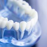 Convalescenza dopo impianto dentale