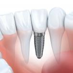 Costo impianto dentale Croazia
