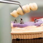 Denti fissi con impianto
