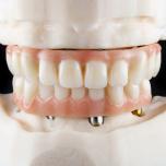 Denti fissi in titanio