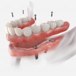 Denti fissi su 4 impianti