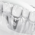Denti fissi toronto