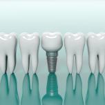 Denti impianto