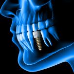 Estrazione dente e impianto costo