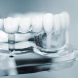Impianti dentali gratis