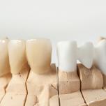 Impianti dentali in zirconio