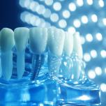 Impianti dentali inclinati 