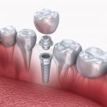 Gli impianti dentali