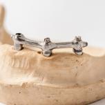 impianto dentale 3 denti