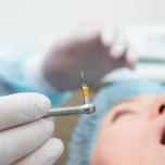 Impianto dentale 4 denti