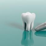 Impianto dentale come funziona